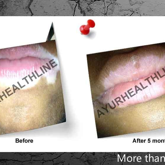 Ayurhealthline Vitiligo Speciality Clinic