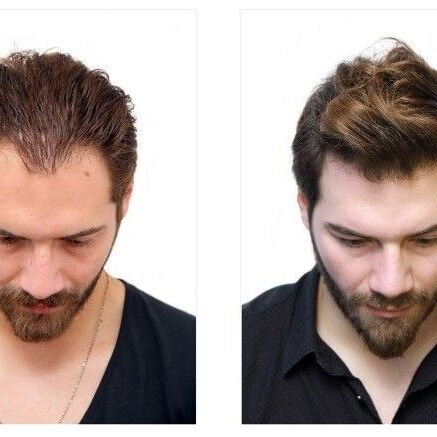 growuphairtransplant