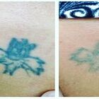 Unwanted Tattoos