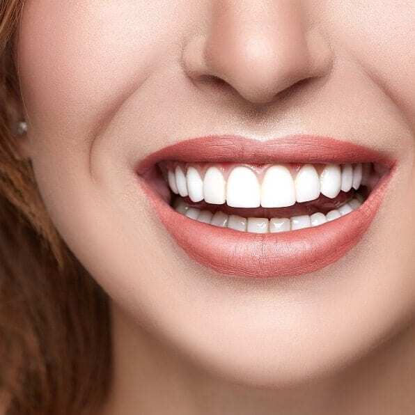 Permanent Veneers