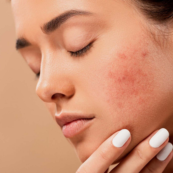 Acne Scar Treatment In Dubai