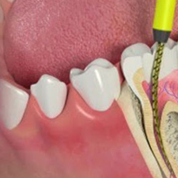 Root Canal Treatment in India