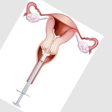 Ici Insemination Kit