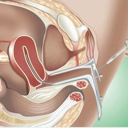 Iui At Home Insemination